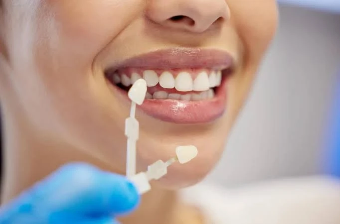 How to Care for Your Veneers After Treatment